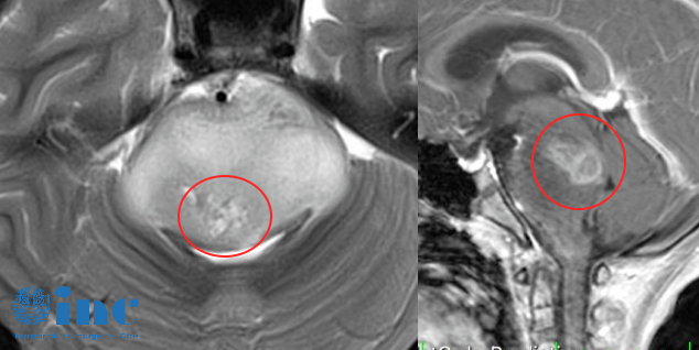 脑桥弥漫中线胶质瘤还有手术机会吗？