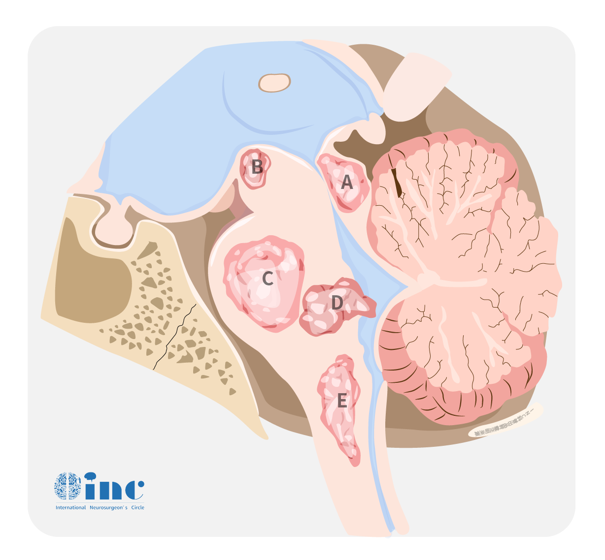 脑干中脑顶盖胶质瘤严重吗？