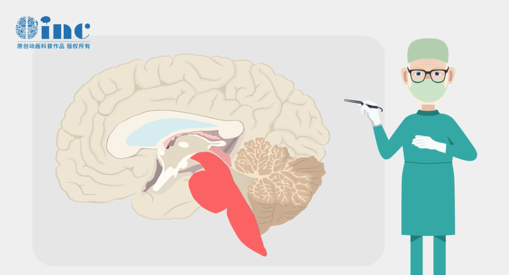 脑干胶质瘤2级偏瘫，脑干发育不良性神经胶质瘤