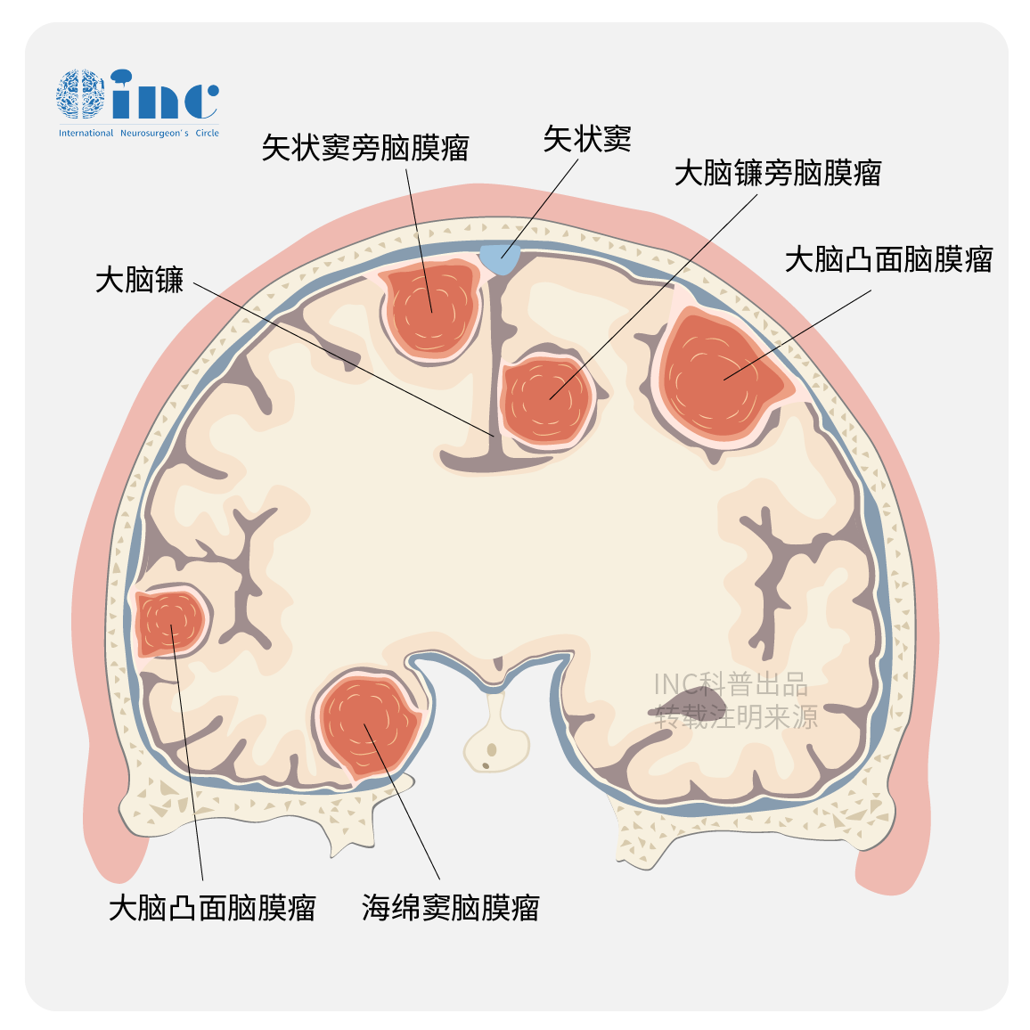 什么是矢状窦旁脑膜瘤？