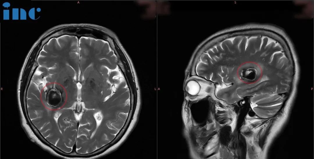 68岁罹患基底节海绵状血管瘤