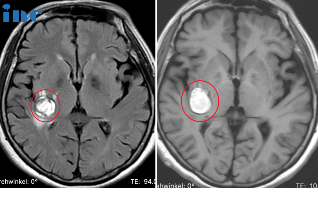 INC巴教授远程评估意见