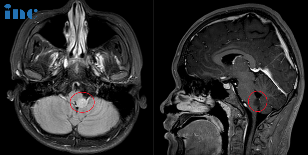 延髓占位性病变手术风险较大，只能保守治疗吗