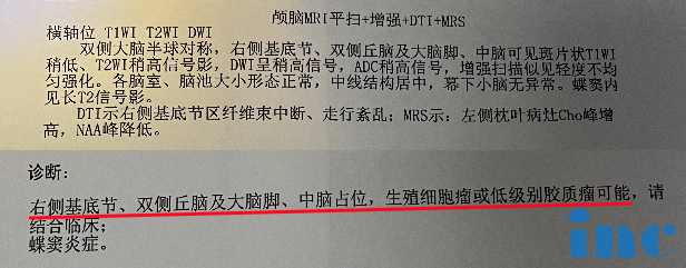 17岁女孩，右侧基底节双侧丘脑及大脑脚，中脑弥漫病变