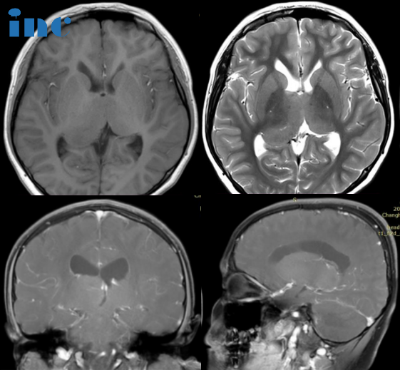 10岁男孩，双侧丘脑占位-胶质瘤需要手术吗