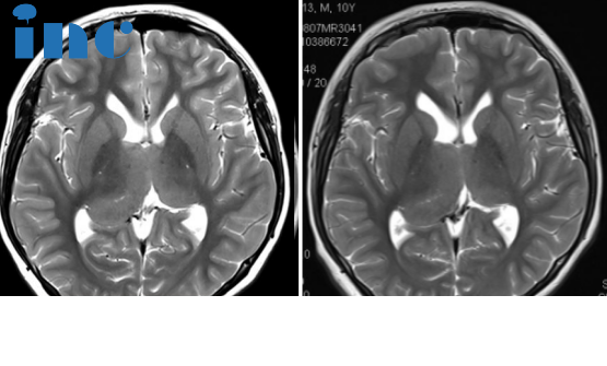 10岁男孩双侧丘脑占位胶质瘤