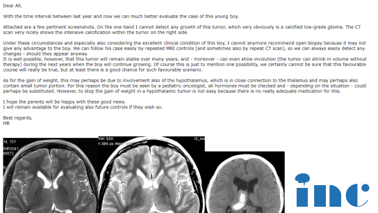 10岁男孩，双侧丘脑占位-胶质瘤一定需要手术吗
