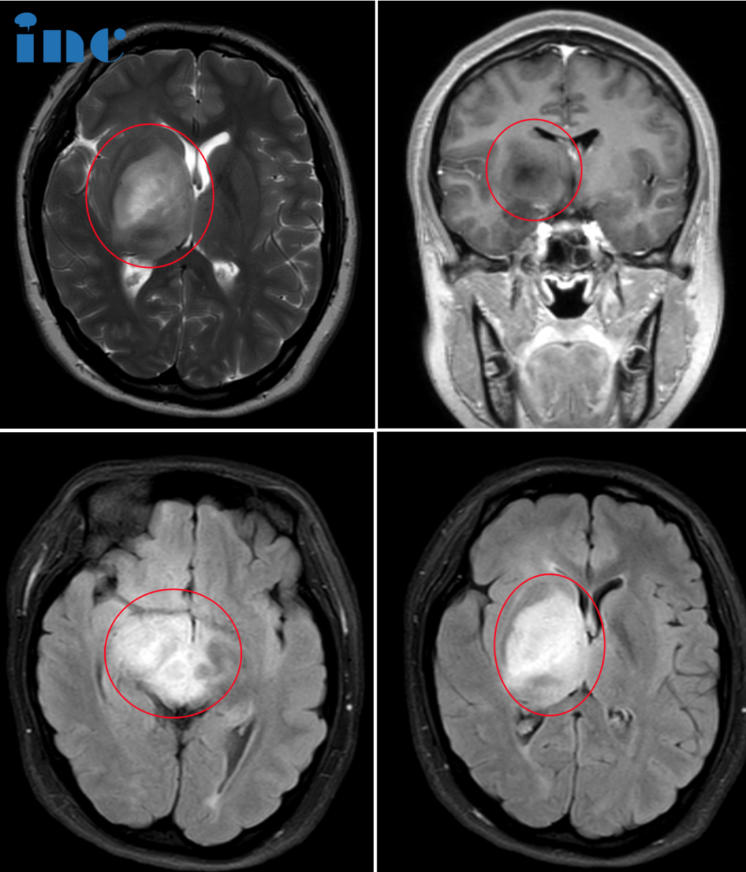 17岁女孩，右侧基底节，双侧丘脑及大脑脚，中脑弥漫病变，可以手术吗？