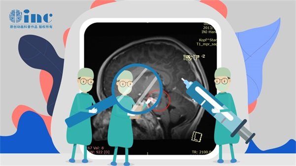 大脑右侧顶叶胶质瘤是什么？严重吗？