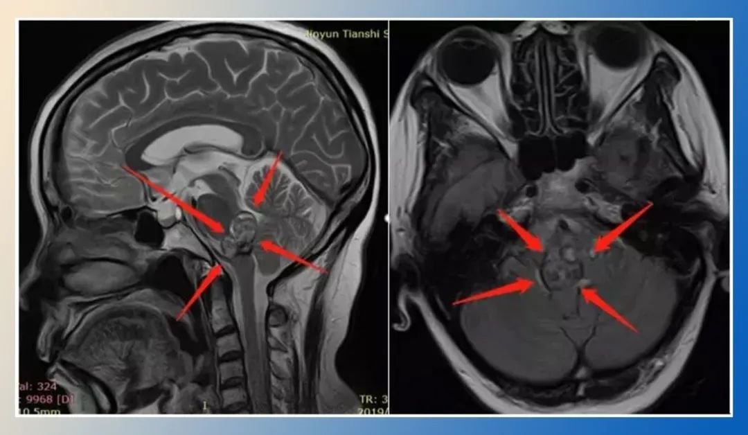 脑干脑桥海绵状血管瘤患者：6次脑干出血6次过“鬼门关”，如何“死里逃生”？