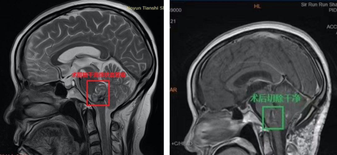 脑干脑桥海绵状血管瘤全切案例