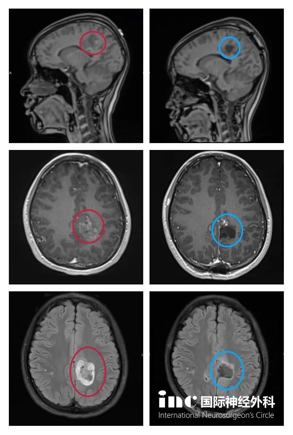 功能区胶质瘤术前术后影像对比