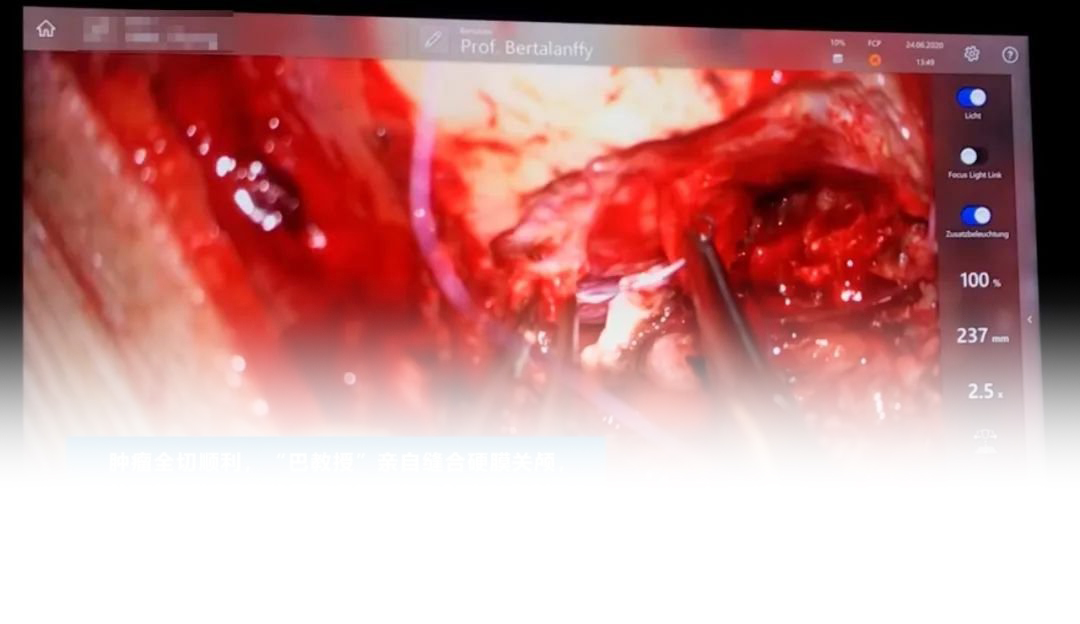 颈髓海绵状血管瘤治疗