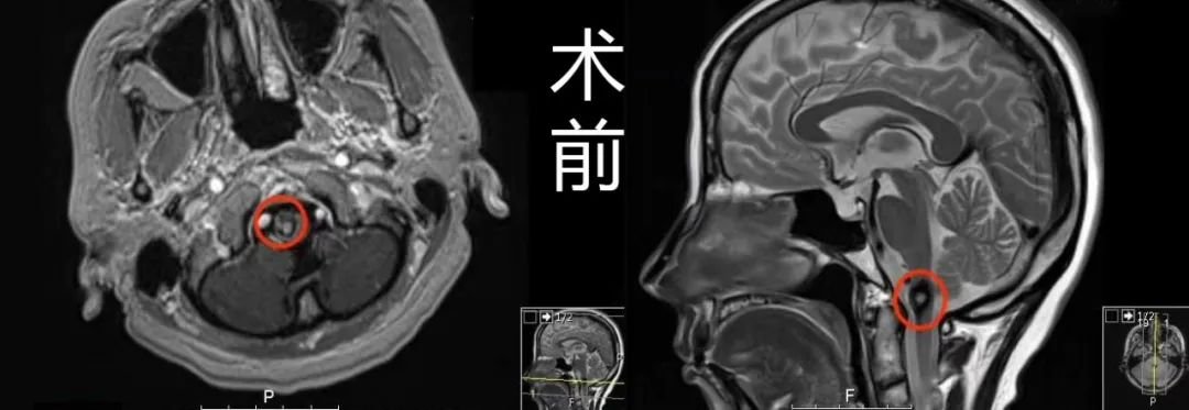 颈髓海绵状血管瘤术前MR