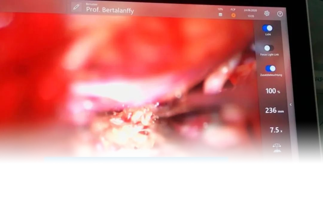 颈髓海绵状血管瘤