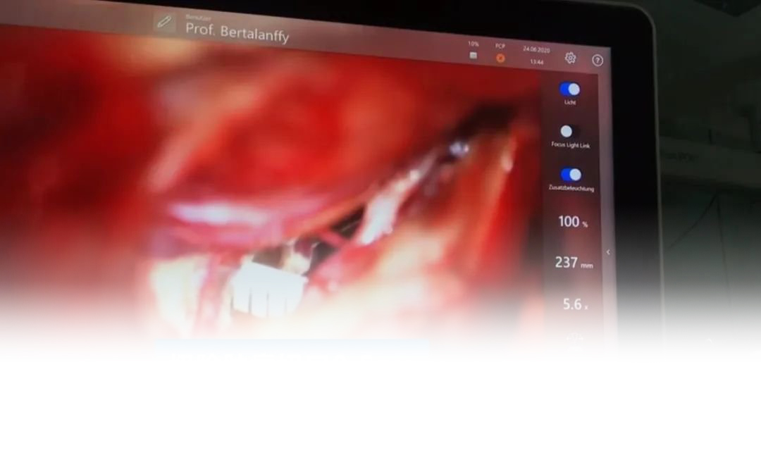 颈髓海绵状血管瘤