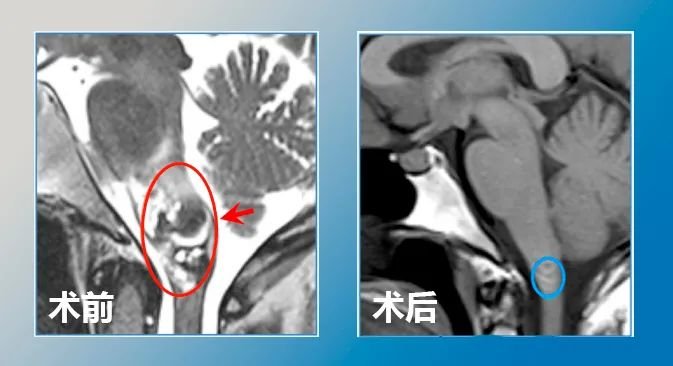 脑干海绵状血管瘤术后