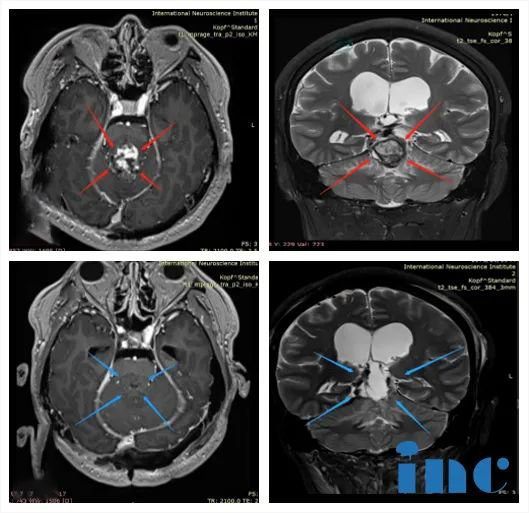 松果体区肿瘤术后