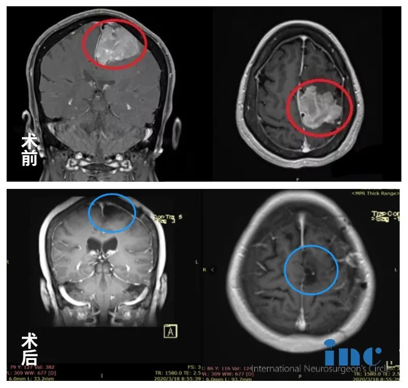 矢状窦旁脑膜瘤术后