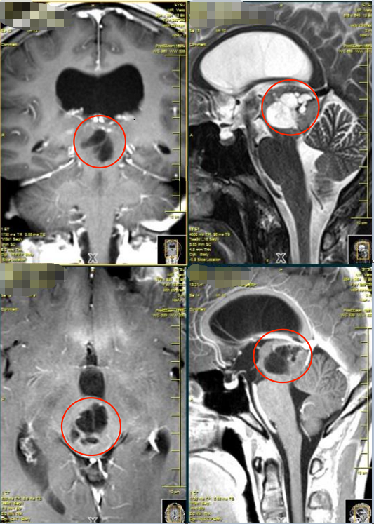 脑干胶质瘤MR