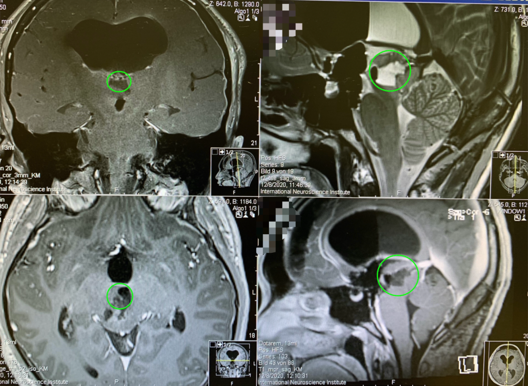 脑干胶质瘤MRI