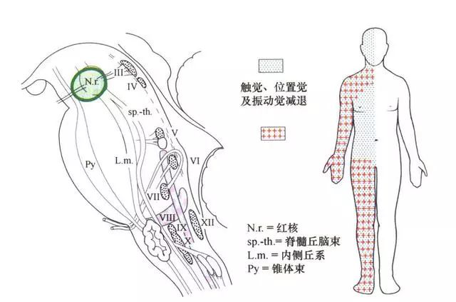 巨大脑干海绵状血管瘤自述