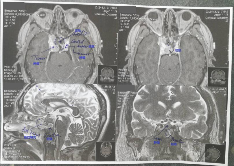 鼻咽癌术前术后影像