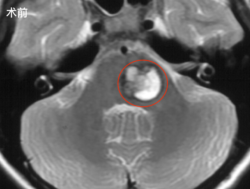 视物重影、肢体无力，学霸不幸患脑干海绵状血管瘤伴脑干出血，这难题怎解？