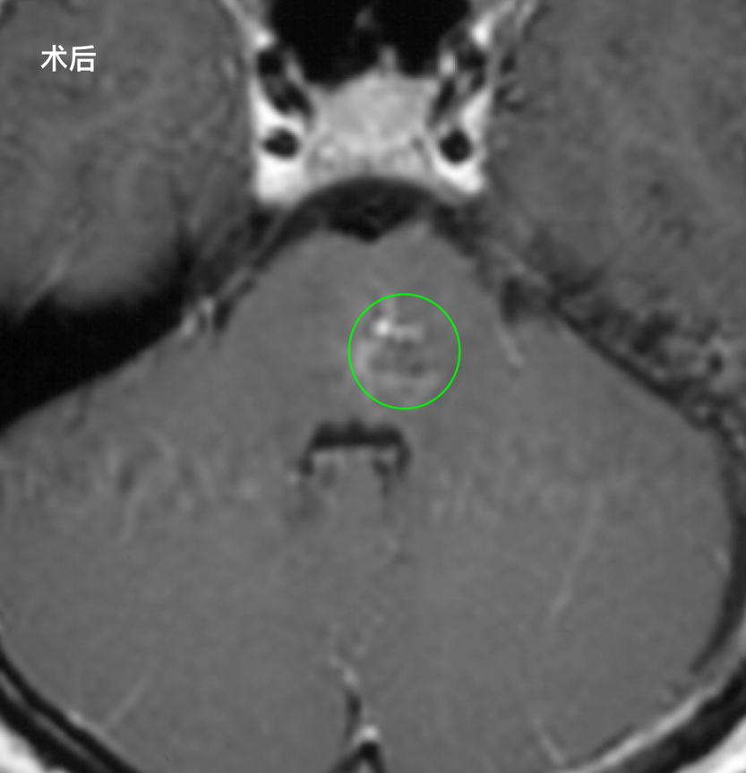 脑干海绵状血管瘤术后复查