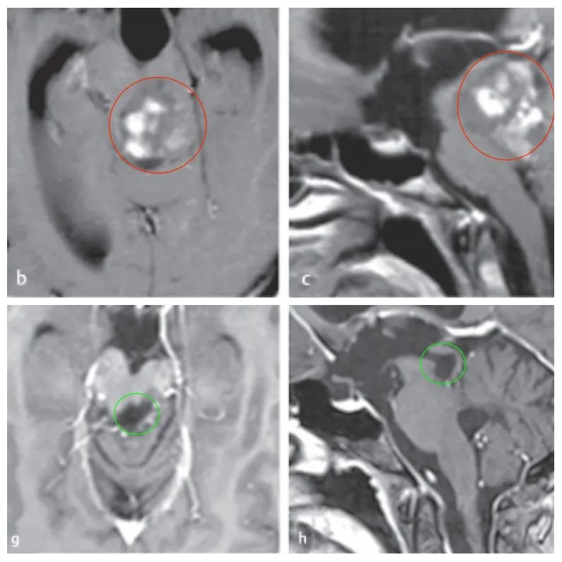 脑干胶质瘤术后MRI