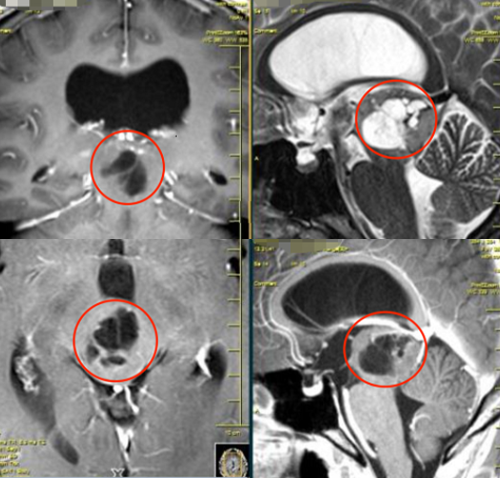 脑干-中脑胶质瘤术前影像