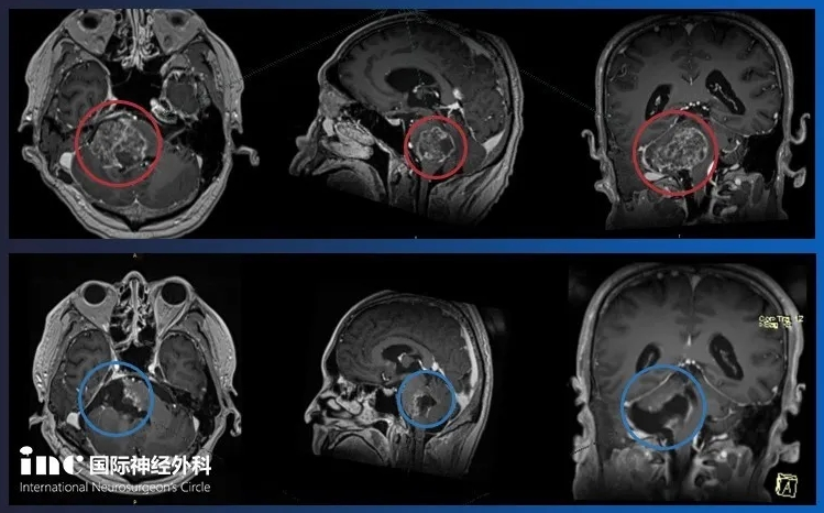 弥漫性脑干胶质瘤术前术后影像