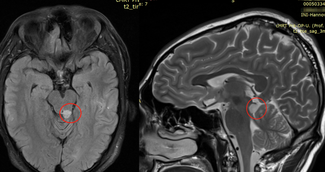脑干-顶盖胶质瘤术前影像