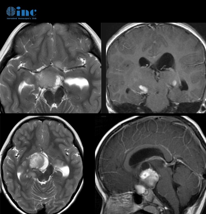 3岁患儿如何摆脱脑瘤、拯救视力？双侧视神经、下丘脑胶质瘤治疗记录