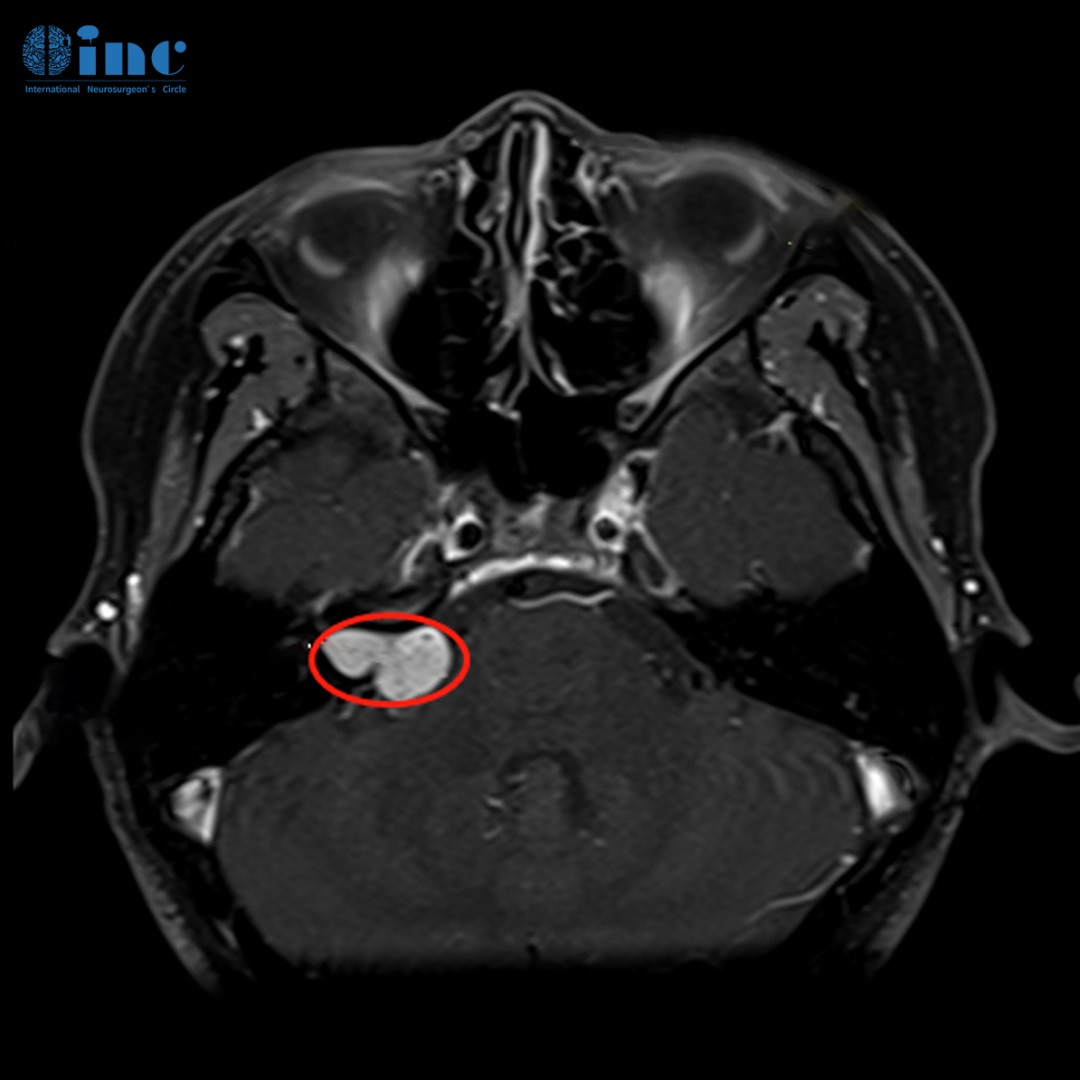 听神经瘤MR