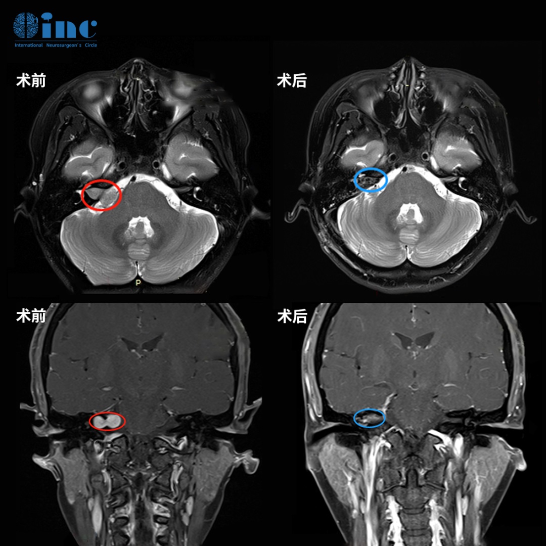 听神经瘤术前术后对比
