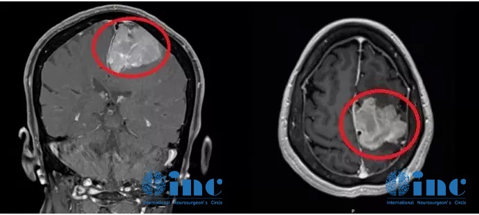 脑膜瘤术前