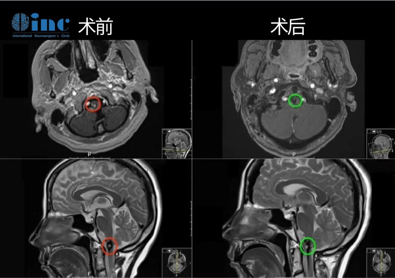 脑干海绵状血管瘤影像对比