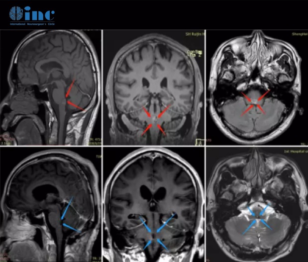 脑干海绵状血管瘤影像对比