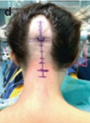 松果体区海绵状血管瘤