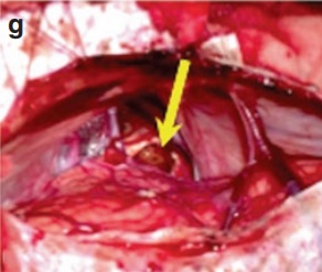 松果体区海绵状血管瘤