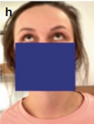 松果体区海绵状血管瘤术后