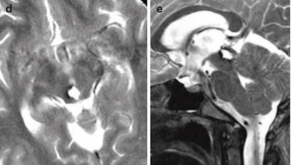 松果体区海绵状血管瘤
