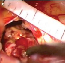 松果体区海绵状血管瘤