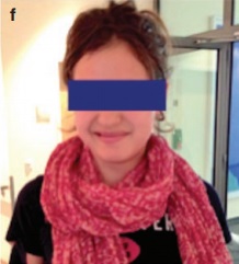 松果体区海绵状血管瘤