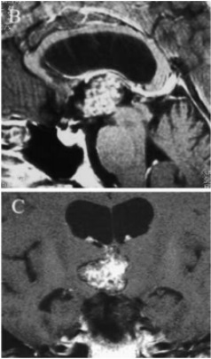 丘脑海绵状血管瘤