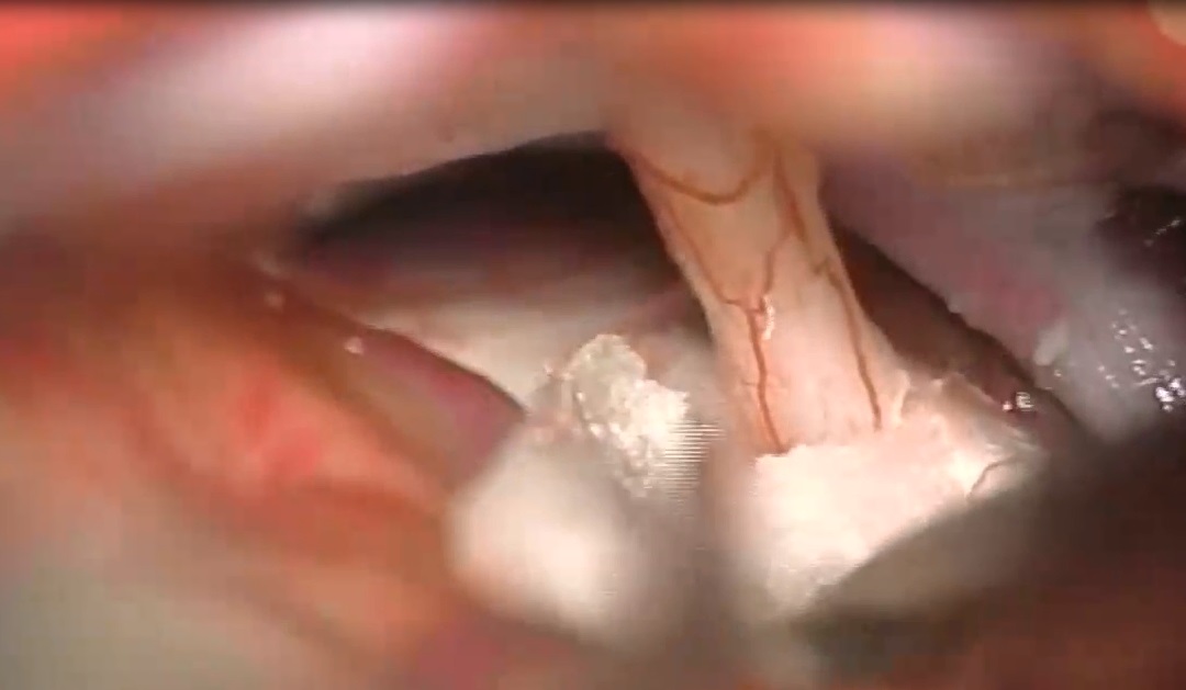 复杂视神经-下丘脑胶质瘤