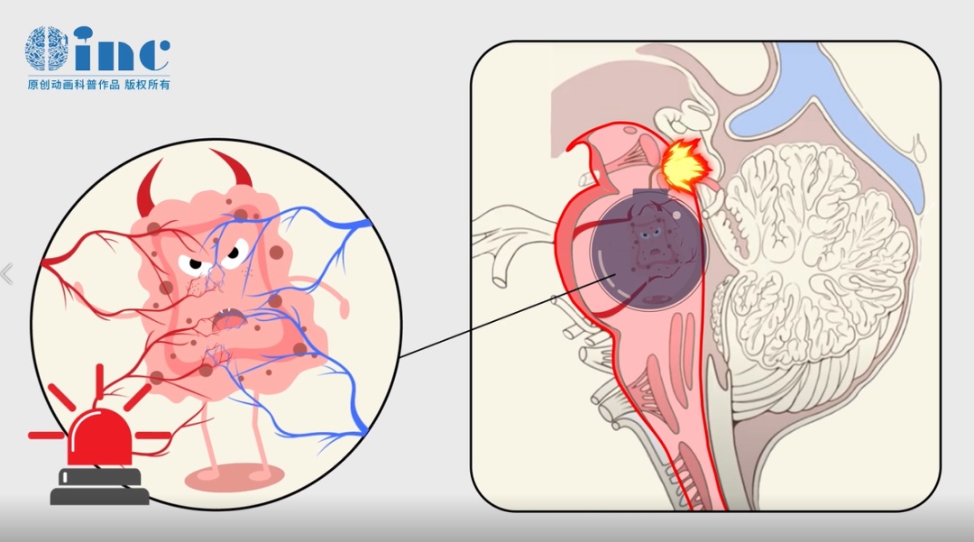 脑干海绵状血管瘤