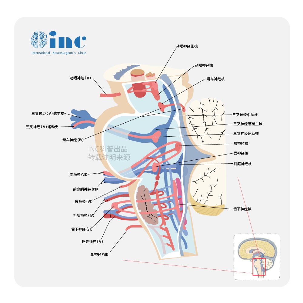 脑干海绵状血管瘤