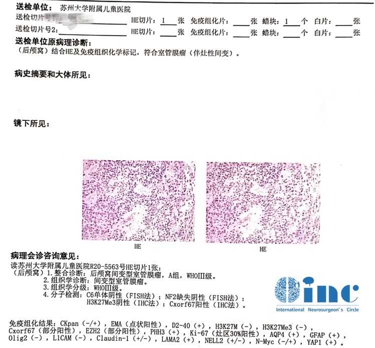 室管膜瘤病理报告